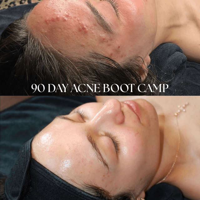 Acne Boot Camp (Includes Products) at Not the Body Shop in Littleton, CO
